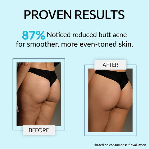 Bum Body Cream with Retistar & Shea Butter for Butt Acne 100g